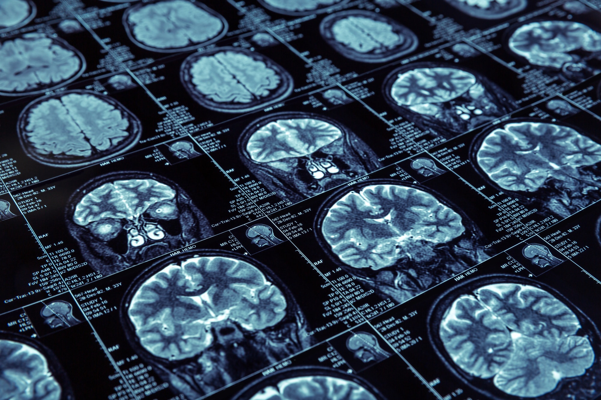 Biological age, brain aging